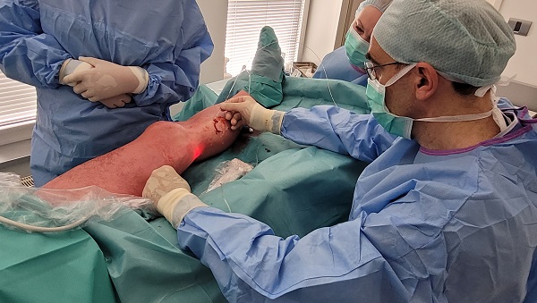 trudimo izboljšati operativno tehniko operacije krčnih žil, cilj je, da se prodre na področje, ki je trenutno še domena klasične operacije krčnih žil.